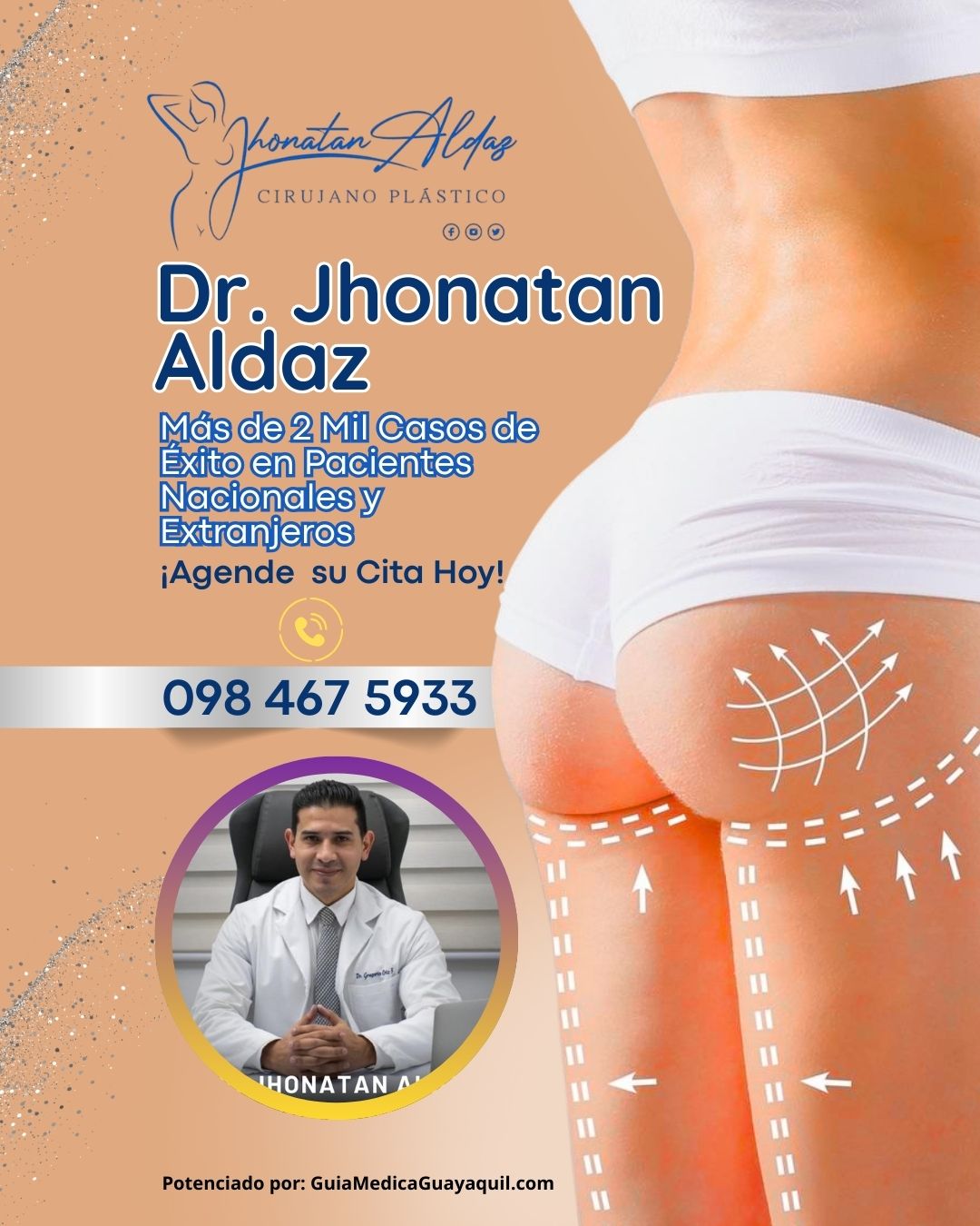 Dr. Jhonatan Aldaz : Aumento de Gl&uacute;teos en Quito - Buttock Augmentation in Quito
