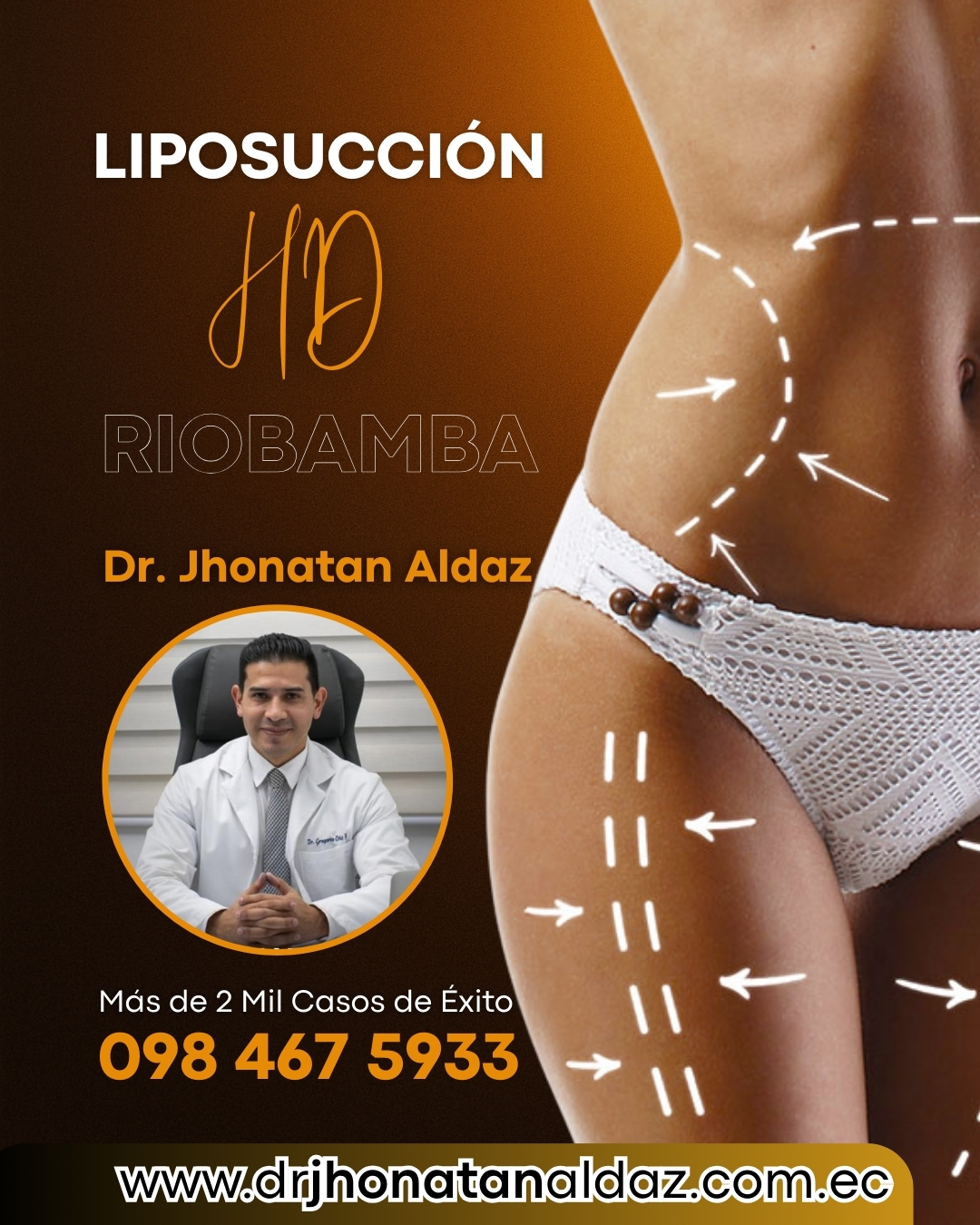 Dr. Jhonatan Aldaz : Liposucci&oacute;n HD en Riobamba - HD Liposuction in Riobamba